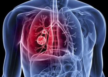 Καρκίνος πνεύμονα: Η επικίνδυνη διατροφική παγίδα μέσα στην κουζίνα